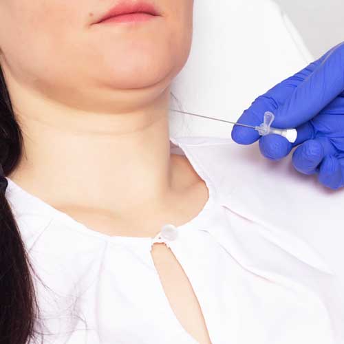 image of the Double Chin treatment